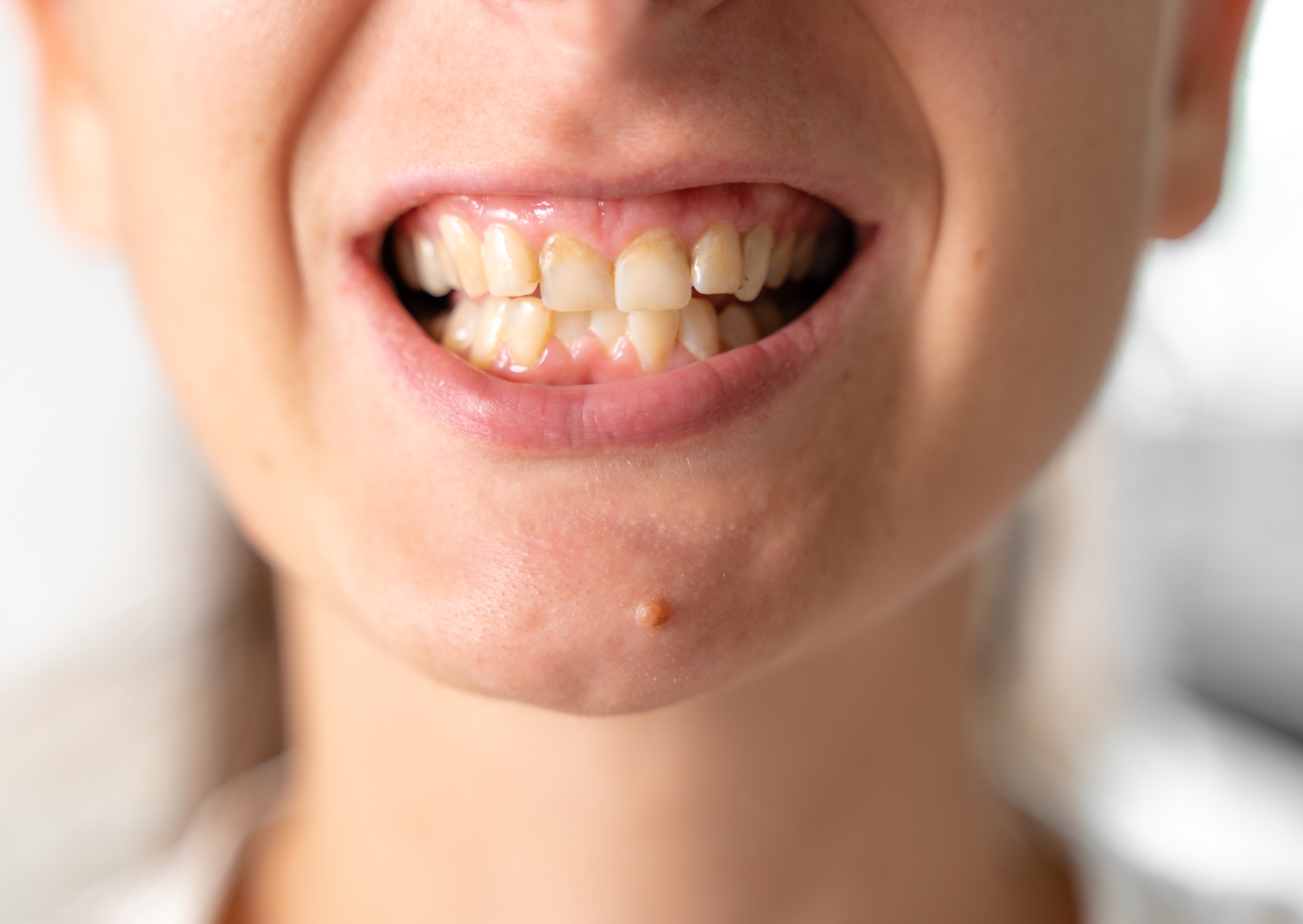 british teeth 2