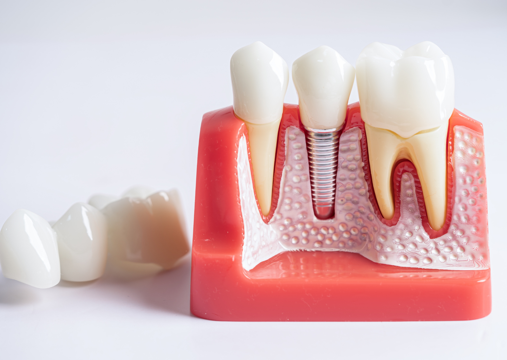 Portuguese Dentist Did Root Canal For €250 — U.S. Quote Was $3,200 4 root canal 4