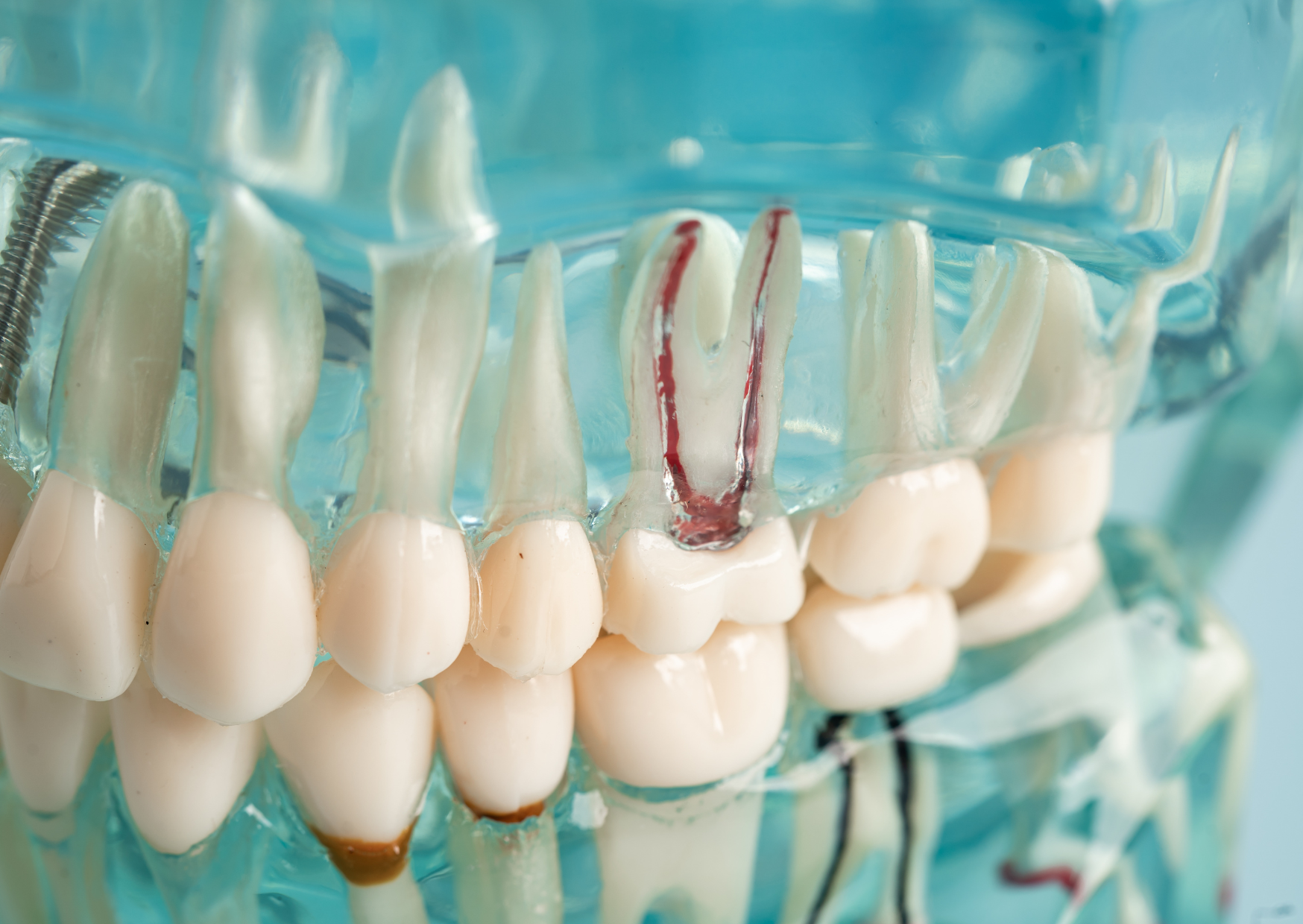 Portuguese Dentist Did Root Canal For €250 — U.S. Quote Was $3,200 6 root canal 6